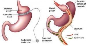 lap-band-vs-gastric-bypass